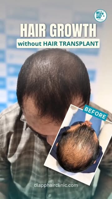 #dlapp #hairgrowth #hairlosstreatment #hairfalltreatment #hairtransformation