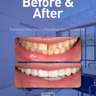 ✨ 𝐁𝐞𝐟𝐨𝐫𝐞 & 𝐀𝐟𝐭𝐞𝐫 – 𝐀 𝐒𝐦𝐢𝐥𝐞 𝐓𝐫𝐚𝐧𝐬𝐟𝐨𝐫𝐦𝐚𝐭𝐢𝐨𝐧

Every smile is unique. Wit