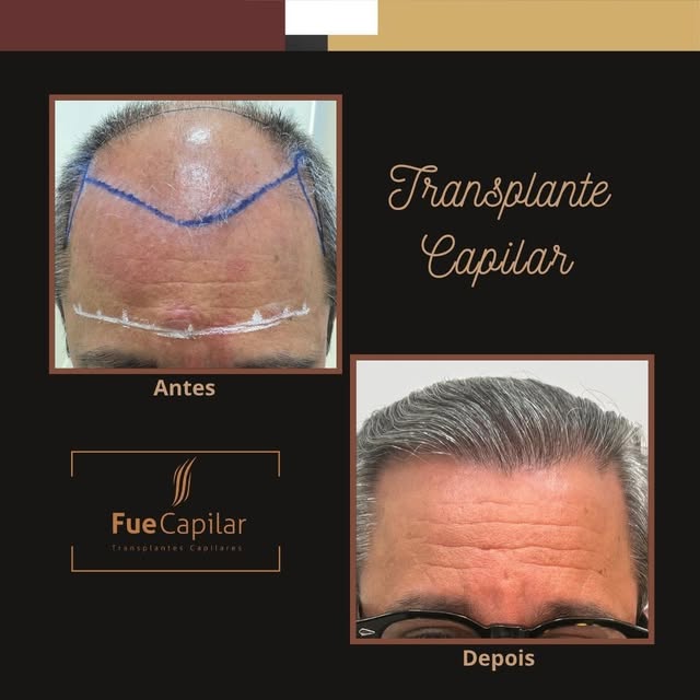 Não adie mais o seu transplante capilar. 🧑‍⚕️

Se a queda de cabelo, as entradas ou a calvície estã