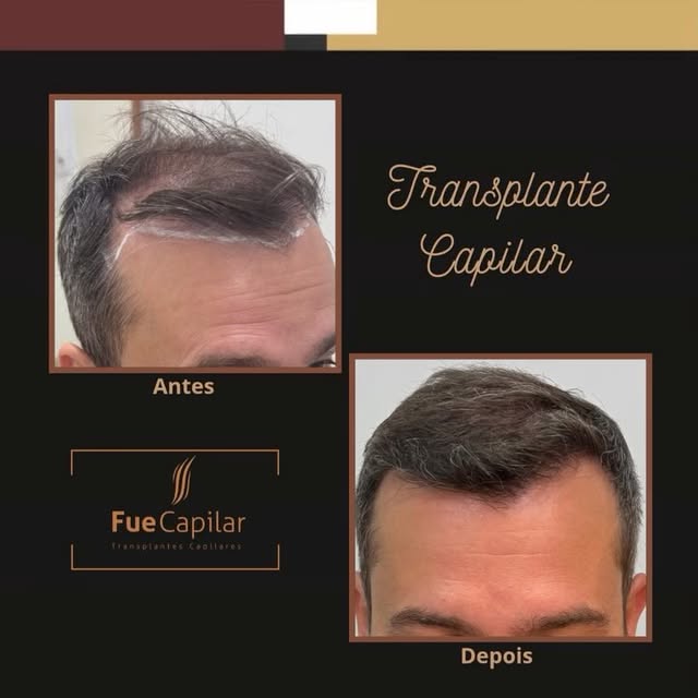 Não adie mais o seu transplante capilar. 🧑‍⚕️

Se a queda de cabelo, as entradas ou a calvície estã
