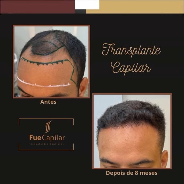 Não adie mais o seu transplante capilar. 🧑‍⚕️

Se a queda de cabelo, as entradas ou a calvície estã