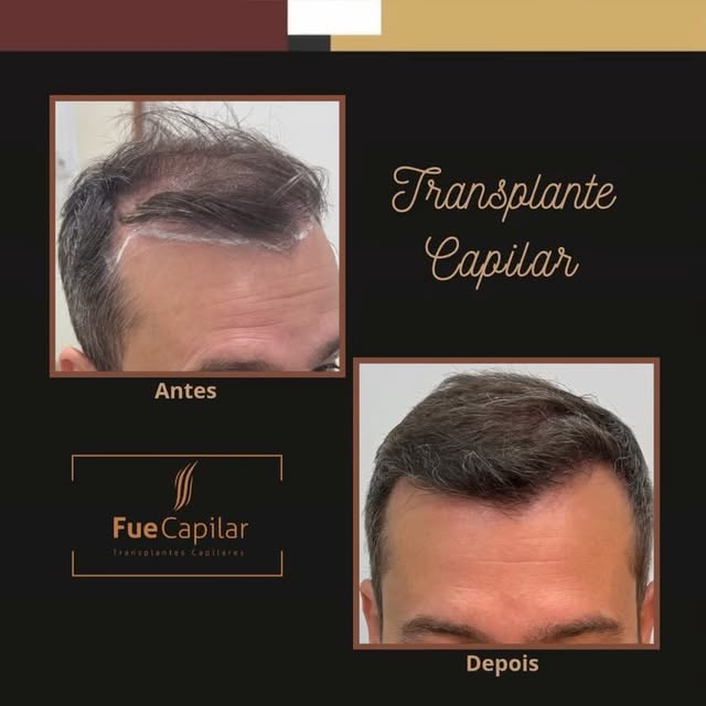 Não adie mais o seu transplante capilar. 🧑‍⚕️

Se a queda de cabelo, as entradas ou a calvície estã