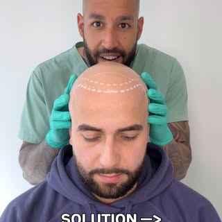 The Solution ☑️

From bald  to the shaved look and completely confident! 

SMP offers the solution t