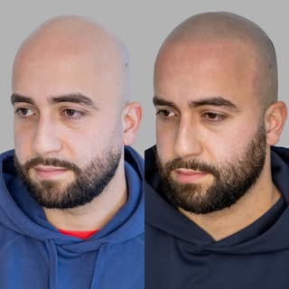Before → After ✨

Witness this incredible transformation!
He chose a soft hairline with a natural, s