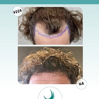✨ Een prachtig resultaat ✨  Onze cliënt kan weer van een volle bos met krullen genieten! 🤩 

Meer w