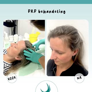 Een PRP-behandeling kan helpen om het haar sterker en voller te maken. Met een kleine ingreep, kom j