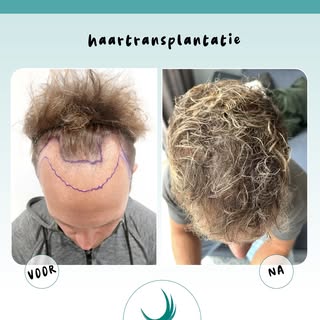 ✨ Van dunner haar naar een prachtig resultaat met een prachtige nieuwe haarlijn!  Wij zijn trots! 🤩