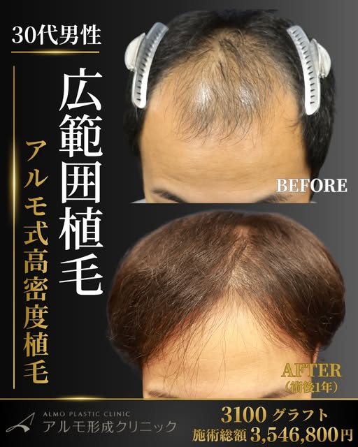 .
広範囲の薄毛に、将来まで見据えた植毛設計を。

— CASE REPORT｜症例紹介 —
5年前に他院様を受診し、AGA内服治療を継続されていましたが、その後も薄毛の進行がみられ、生え際から前頭部