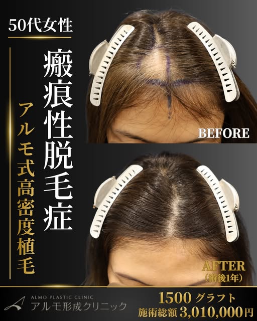 .
瘢痕性脱毛症による前頭部の透け感を改善。

— CASE REPORT｜症例紹介 —
前頭部の瘢痕性脱毛症でお悩みだった、50代女性の症例です。

瘢痕性脱毛症によって前頭部のボリューム低下が目立