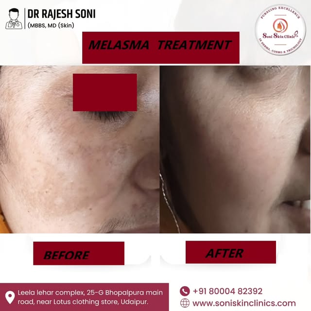 ✨Melasma Treatment – Visible Improvement, Better Confidence!
Melasma can be effectively managed with