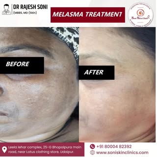 ✨ MELASMA TREATMENT – BEFORE & AFTER ✨

Visible improvement in facial pigmentation with a personaliz