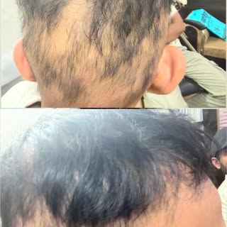🧑‍⚕️ Alopecia Areata – Hair Loss Can Be Treatable!

Alopecia areata is an autoimmune condition that