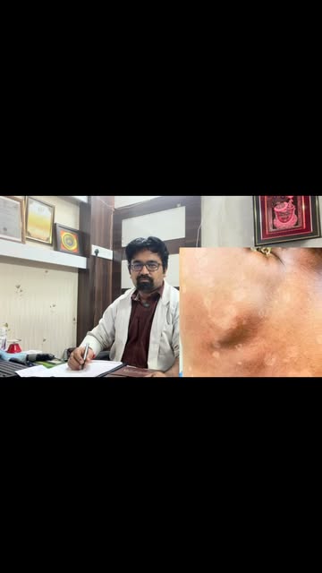 ✨ Pityriasis versicolor is a common fungal infection that causes light or dark patches with fine sca