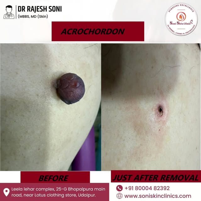 Acrochordon (Skin Tag) Removal ✨

A skin tag is a common benign skin growth, often seen around the n