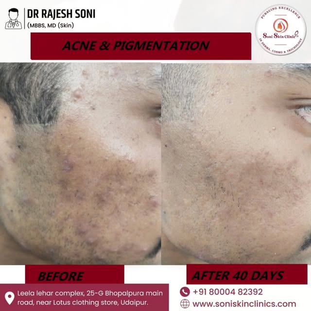 ✨Acne, active breakouts and post-acne pigmentation can often be managed effectively with a personali