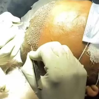 "Rediscover your confidence with a full head of hair! At Honnete Aesthetics, we specialize in transf