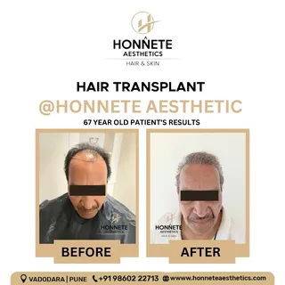 #honneteaesthetics #satisfied #hairtransplant #hairtransformation #results #67yearsold