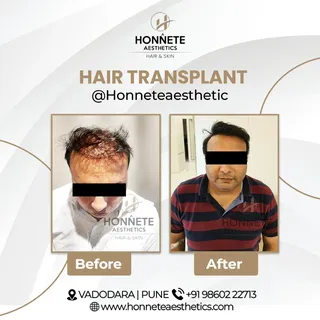 #hairtransplant #hairtransplantation #results  #7months