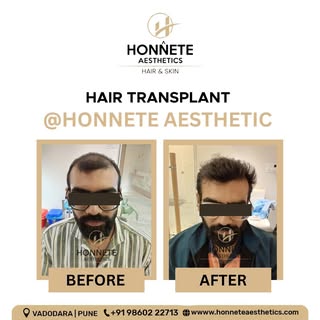 ✨ Transformation that speaks for itself!
From hair thinning worries to a confident new look – our cl