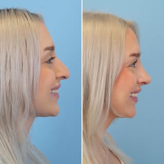Love this patient’s early result just 3 weeks after her #rhinoplasty !! 

⠀⠀⠀⠀⠀⠀⠀⠀⠀
To see me as a p