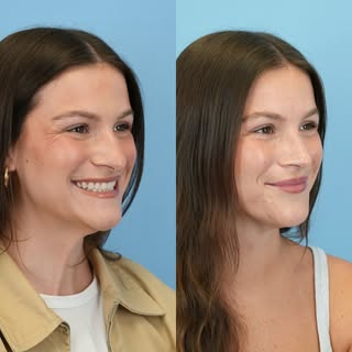 3 months post septorhinoplasty ✨softer, refined, elegant and *most importantly* still looking like h