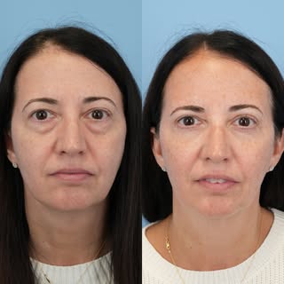Before & 3 months post upper and lower blepharoplasty with fat transfer!