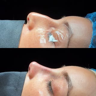 Before & immediately after #rhinoplasty 🤌🏻