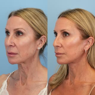 2 months post deep plane face and neck lift with fat transfer looking amazing and refreshed ✨