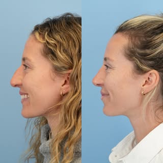Before & 3 months after septorhinoplasty ✨ the goal was for natural refinement and to keep her looki