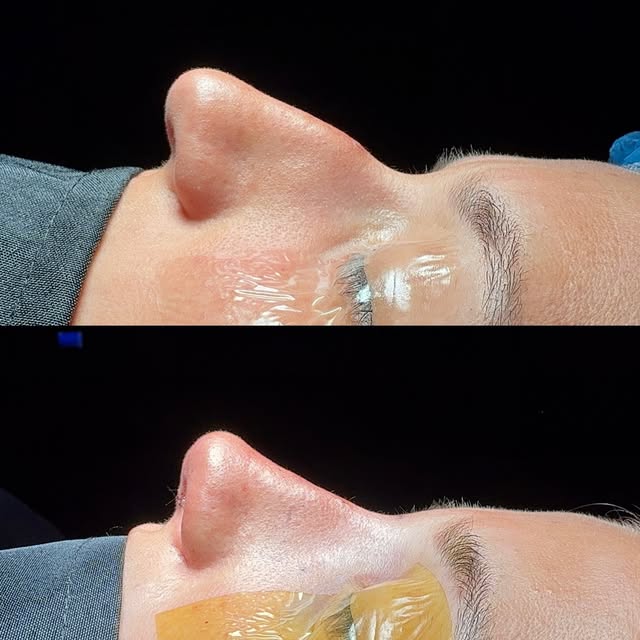 These rhinoplasty results lately 😮‍💨