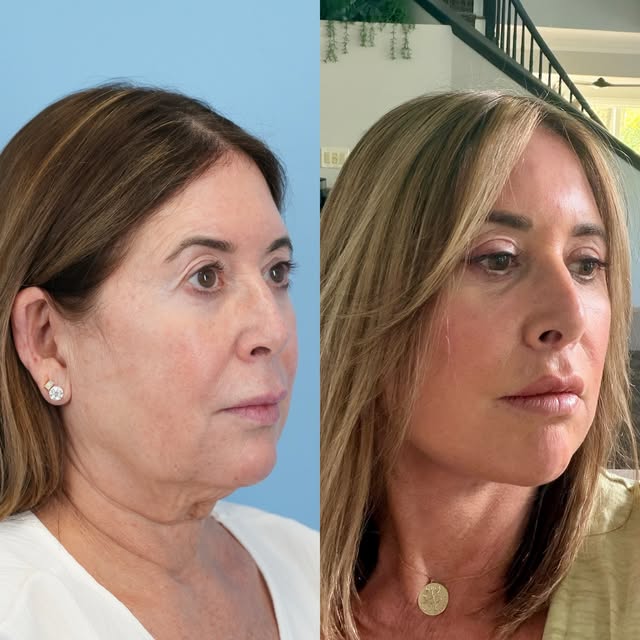 I was so happy to receive these pictures from my amazing patient who is just 2 months out from her d
