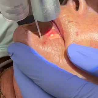 Transform your skin from the inside out with UltraClear™ — the next generation in laser technology. 