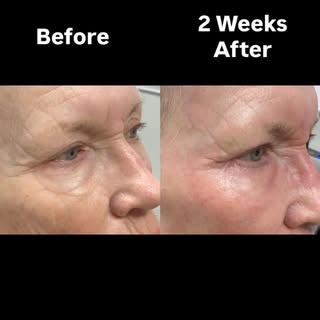 This patient experienced an amazing transformation with just one treatment with the UltraClear laser