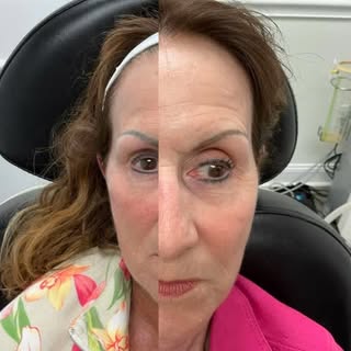 That post-treatment glow 😊— thanks to the UltraClear laser treatment, her skin has visible improvem