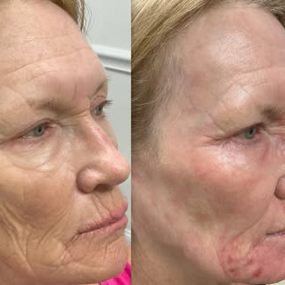 Amazing Transformation in Just 2 Weeks with UltraClear Laser! 

Crow’s feet and deep under-eye wrink