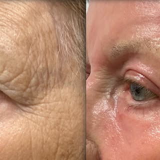 Real patient, Real results ➡️ At 4 weeks post CO₂, we’re already seeing smoother, more refined skin 