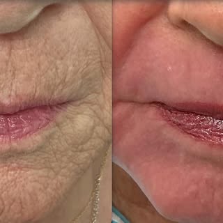 Wrinkles? Relaxed. Skin? Reset. 🔄 

Just 2 weeks post-CO₂ and the difference speaks for itself. Sof