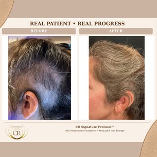 REAL PATIENT. REAL PROGRESS. 🤎

We’re only at treatment #3 with this patient, and this is the kind 