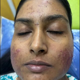 Salicylic acid peel / chemical peel / acne peel / pimples peel/  #druttamlenkaclinic@acnetreatment