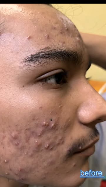 #acnetreatments #acne #skintreatments #DrUttamLenka #dermatologist