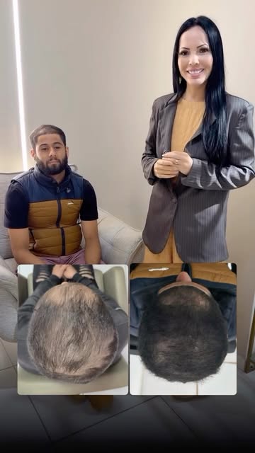 Uma evolução maravilhosa para acompanhar! ✨

Esse paciente chegou com os fios bem ralinhos e falhas 