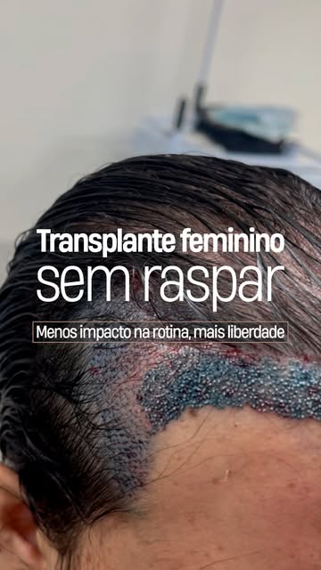 Se a ideia de raspar o cabelo sempre fez você adiar o transplante, eu quero te contar que existem ou