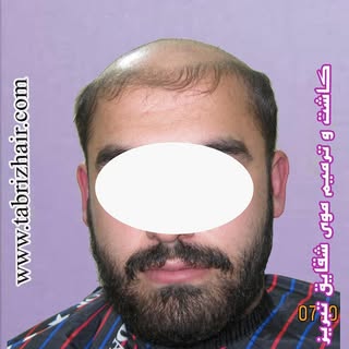 کاشت  و ترمیم  موی  شقایق  در  تبریز 
شماره  تماس :  09144015283 
شماره  تلگرام :  09904498848 
آماد