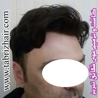 کاشت  و  ترمیم  موی  شقایق  در  تبریز 
شماره  تماس :  09144015283 
شماره  تلگرام :  09904498848 
آما