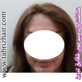 تخصصی  ترین  مرکز  کاشت  و  ترمیم  موی  شقایق 
شماره  تماس :  09144015283 
شماره تلگرام :  099044988