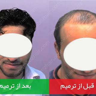 کاشت  و  ترمیم  موی  شقایق  در  تبریز 
آماده  ارائه  خدمات  کاشت  و  ترمیم  مو  با  جدید  ترین  متد 