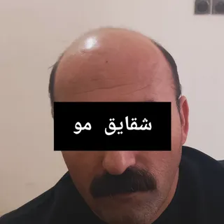 #ترمیم_مو 
#ترمیم_مو_آقایان 
#پروتز_مو 
#تبریز
#ارومیه