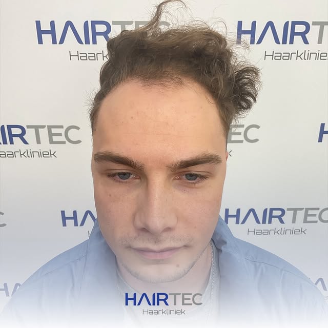 In het voorste gebied werden met de Micro DHI-techniek 3.090 grafts, goed voor 8.485 haren, geïmplan