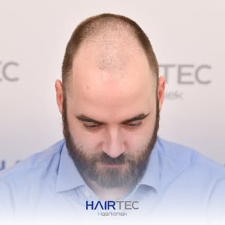 Een natuurlijke haarlijn is nooit kaarsrecht. Vooraan worden eenharige grafts geplaatst voor een zac