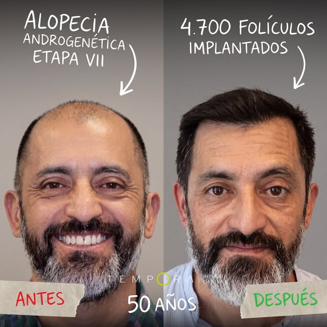 Detrás de un buen resultado de implante capilar no hay casualidad: hay estudio, planificación, una e